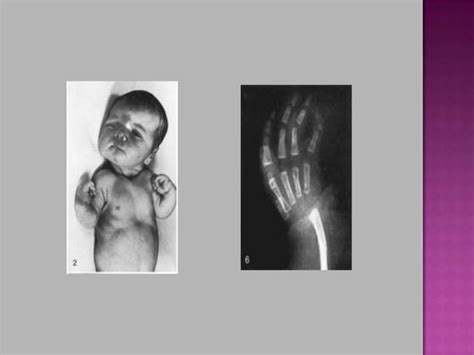 Neonatal Thrombocytopenia PPT