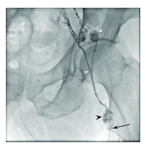 The Fluoroscopic Image Of The Intranodal Lymphangiography That Is