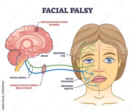 Facial Palsy And Muscles Weakness Because Of Nerve Damage Outline