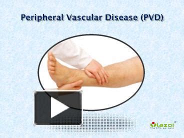 PPT – Peripheral Vascular Disease (PVD) - Causes, Symptoms, Diagnosis ...