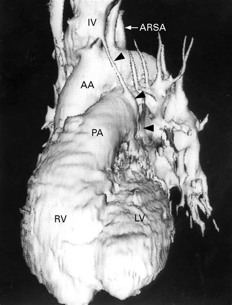 Coronary Sinus Ostial Atresia With Persistent Left Superior Vena Cava