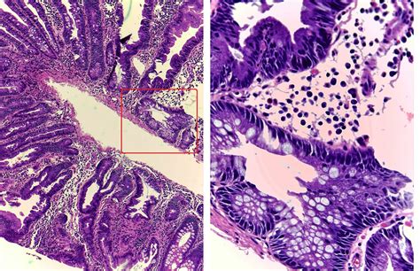 GASTROINTESTINAL AND LIVER HISTOLOGY PATHOLOGY ATLAS: SESSILE SERRATED ...