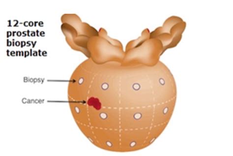 Prostate Biopsy (TRUS or MRI-US fusion Method) | Chin Chong Min Urology ...