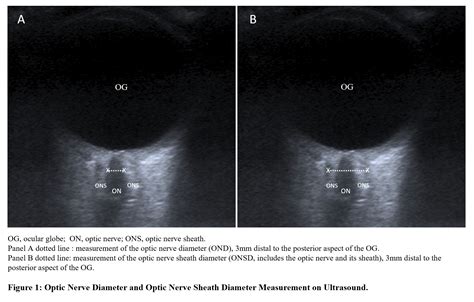 Optic Nerve Sheath Measurement On Ultrasound A Novel Diagnostic Test For Giant Cell Arteritis