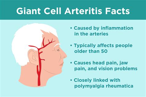 Giant Cell Arteritis: Past and Future - Medcase