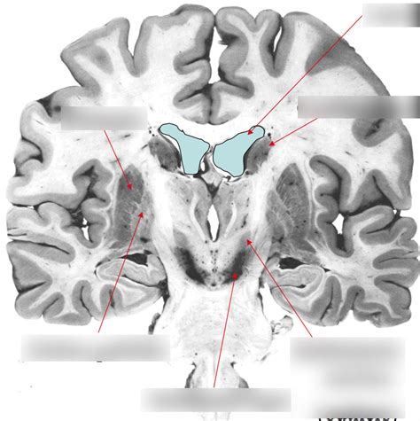 Neuroanatomy Coronal Section Diagram Quizlet