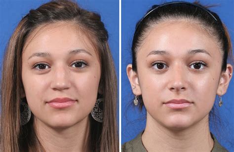 Rhinoplasty Austin Tx Dr Weinfeld