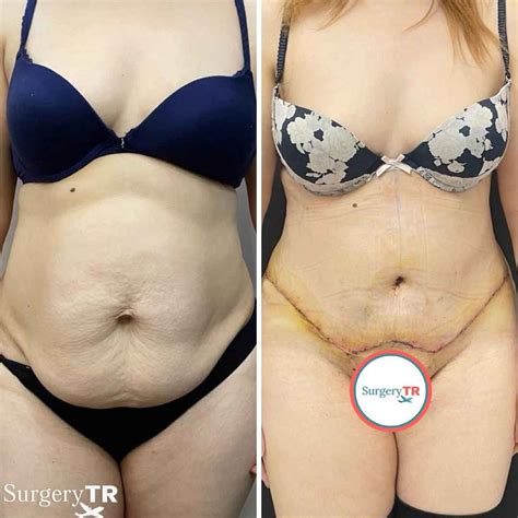 Tummy Tuck In Turkey Abdominoplasty SurgeryTR