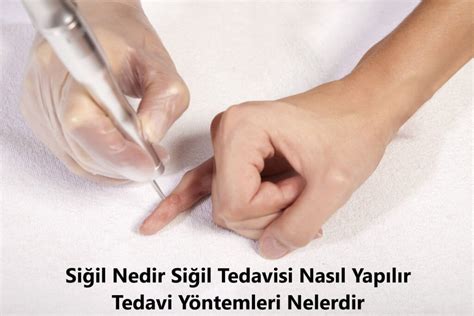 Siğil Nedir Siğil Tedavisi Nasıl Yapılır Tedavi Yöntemleri Nelerdir