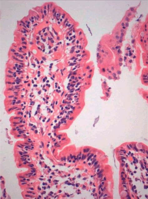 Chapter 15 Coeliac Disease Abdominal Key