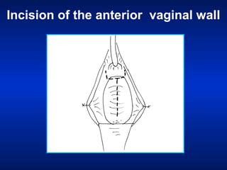 Modified extended anterior vaginal wall repair for cystocele | PPT