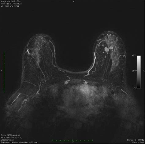 Figure From Mri In The Pre Operative Breast Cancer Staging Before And