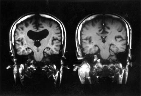 Hydrocephalus Before And After Shunt