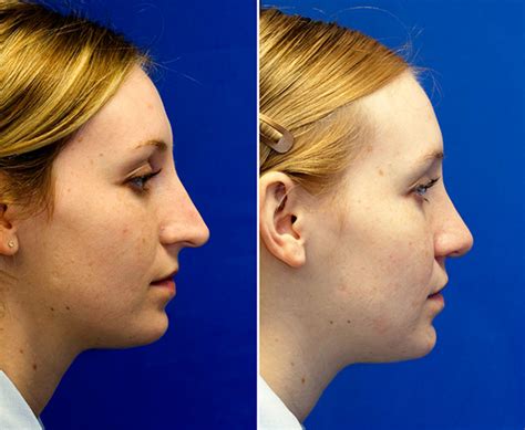 Droopy Ptotic Tip Rhinoplasty In Seattle Rhinoplasty Surgeon