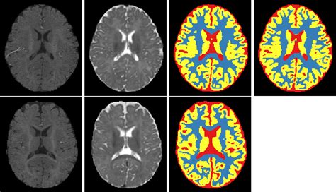 [pdf] Isointense Infant Brain Mri Segmentation With A Dilated