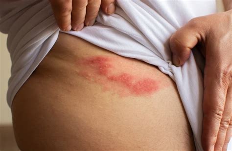 What Is Shingles And Other Shingles Faqs Answered Waters Edge Dermatology