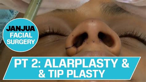 Part 2 African American Alarplasty And Tip Plasty Marking The Nose Dr Tanveer Janjua Youtube