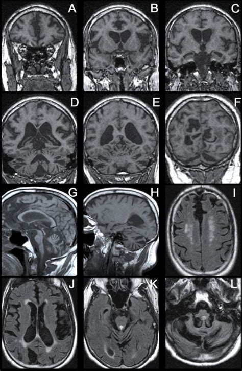 Mri At Age 61 Demonstrating Severe Atrophy Of The Cerebral Hemispheres