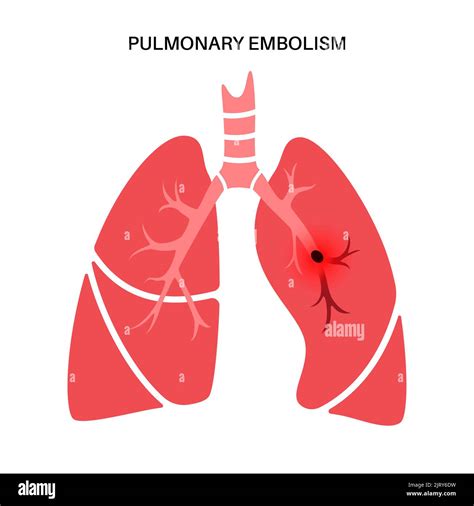 Embolia pulmonar ilustración Fotografía de stock Alamy