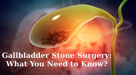 Gallbladder Stone Surgery What You Need To Know