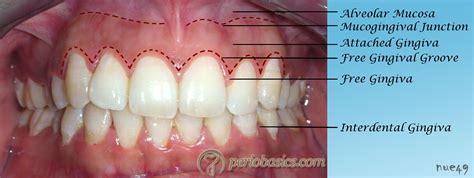 Healthy Gingiva Attached Gingiva Is Non Movable Gingiva As The Name