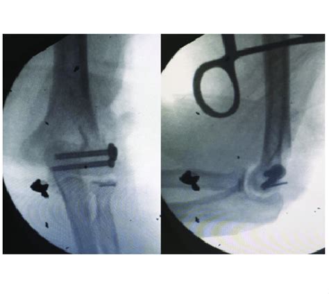 Intraoperative Fluoroscopic Image After Fixation Of The Avulsed Lateral