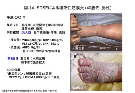 β溶血性レンサ球菌とは 3 劇症型レンサ球菌感染症例 厚生労働科学研究費補助金新型インフルエンザ等新興・再興感染症研究事業 重症型の