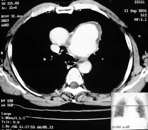 Contrast Enhanced Ct Scan Chest Axial View Showing Large Lobulated