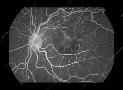 Macular Edema - Stock Image - C027/2267 - Science Photo Library