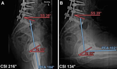 Spinopelvic Motion And Impingement In Total Hip Arthroplasty The