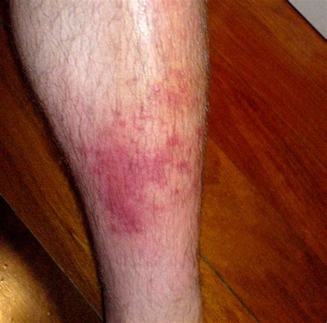 What Is Cellulitis What Causes Cellulitis Infection The Dynamic