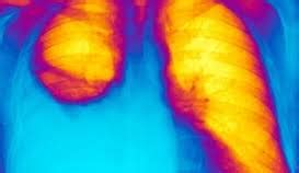 pleurisy  symptoms treatment  prognosis