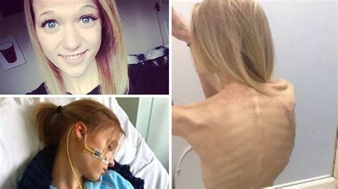 Thinspiration Selfies Almost Killed Me Anorexia Survivors Warning