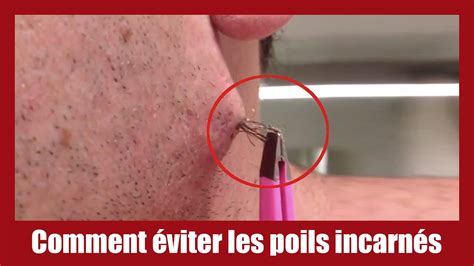 Comment Viter Les Poils Incarn S Youtube