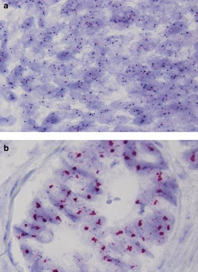 Chromogenic In Situ Hybridization Showing Her2 Gene Normal A And