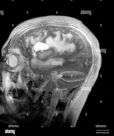 Brain Cancer Sagittal Magnetic Resonance Imaging MRI Scan Through