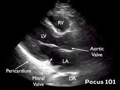 How To Measure Left Ventricular Ejection Fraction Ideas Magnetic