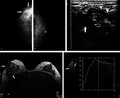 A 41 Year Old Woman With A Palpable Mass In The Outer Upper Quadrant Of