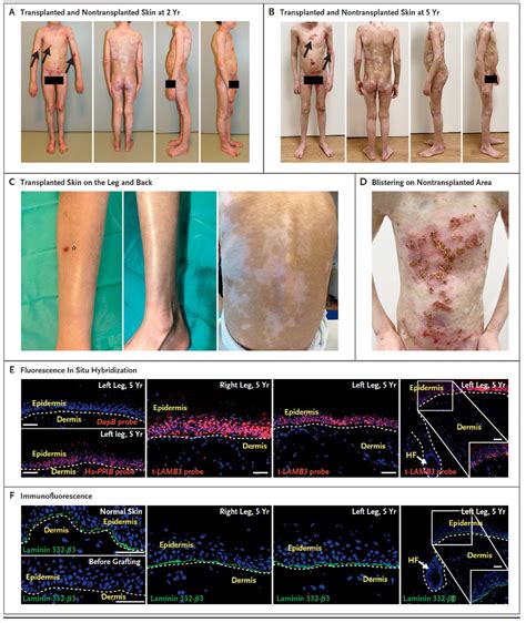 Junctional Epidermolysis Bullosa Herlitz