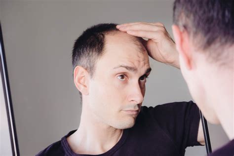 Hair styles for balding men can make you look younger 22