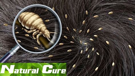 Natural Cure How To Get Rid Of Lice Permanently 9 Home Remedies For Head Lice Youtube