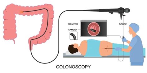 Colonoscopy Colonoscopy: Over 2,868 Royalty-Free Licensable Stock Illustrations & Drawings ...