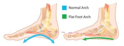 Flatfoot Correction Treatment & Surgery | Spine & Orthopedic Center