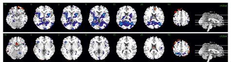 Brain Map Of Neural Activation In Response To Stroop Task In Acute Download Scientific Diagram