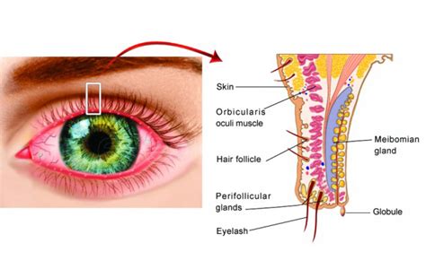 Blepharitis Boise Eyelid Inflammation Idaho