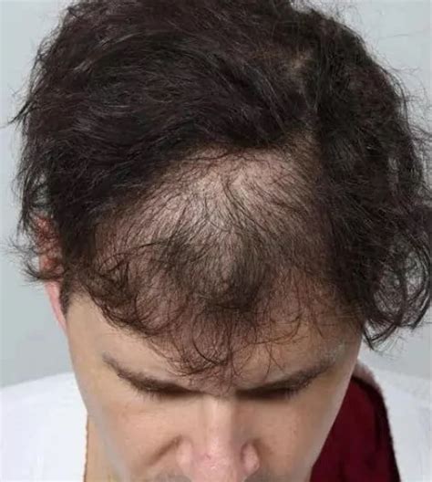 Male Hair Transplant In NYC | HairCareMD