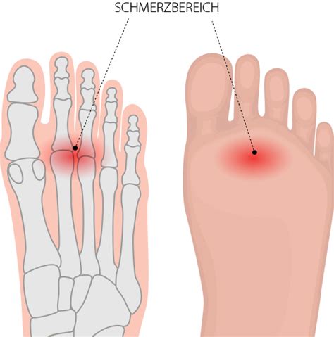 Metatarsalgie Spreizfuß Dr med Matthias Marquardt