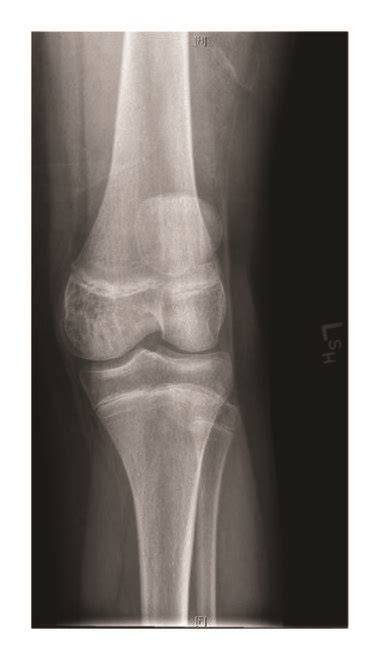 Anteroposterior A And Lateral B Radiographs Of The Left Knee After