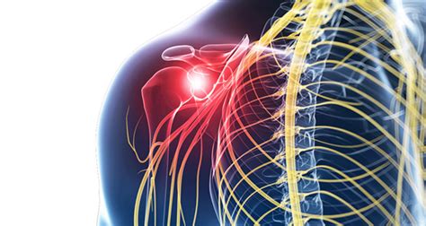 Suprascapular Neuropathy Symptoms Causes And Treatment