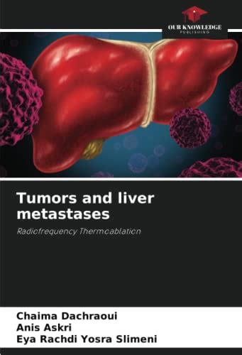 Tumors And Liver Metastases Radiofrequency Thermoablation By Chaima